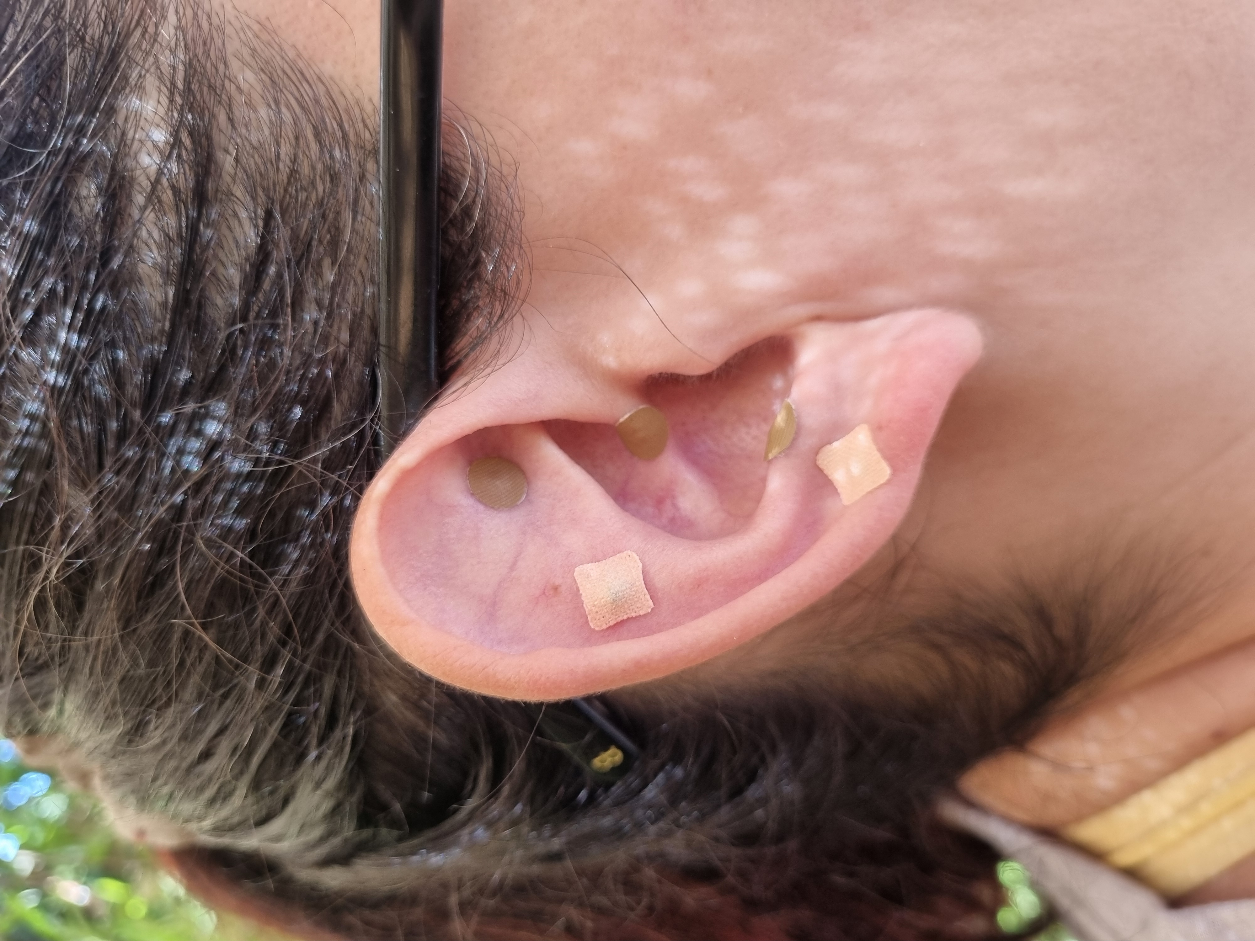 Auriculoterapia